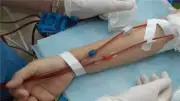 هل يمكن تأخير الغسيل الكلوي؟ استشاري يوضح العوامل المؤثرة