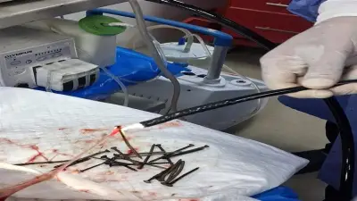 نجاح استخراج 100 مسمار وصامولة من معدة مريض بمنظار دون جراحة في بني سويف