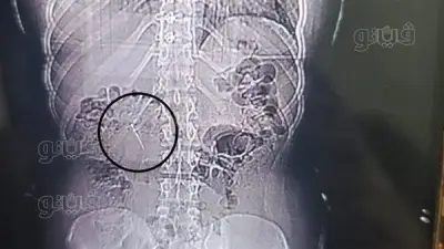أطباء بورسعيد ينقذون فتاة ابتلعت دبوسًا معدنيًا بطول 4 سم