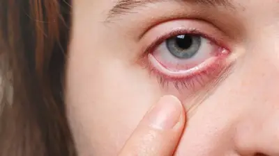 تقنية إعادة التشكيل الكهروميكانيكي لتصحيح النظر.. ثورة في طب العيون