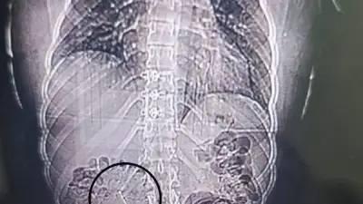 فريق طبي ببورسعيد ينقذ فتاة من مضاعفات خطيرة بعد ابتلاع دبوس