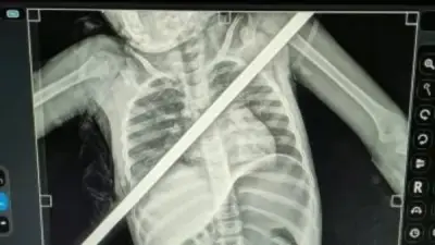 أطباء بنها الجامعي ينقذون طفلة اخترق صدرها سيخ حديدي في عملية معقدة