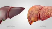 عقار واعد لعلاج الكبد الدهني يظهر نتائج مشجعة في دراسة جديدة