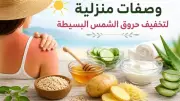 وصفات طبيعية منزلية لتخفيف حروق الشمس البسيطة في الصيف