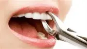 تفسير حلم خلع الضرس في المنام وعلاقته بخسارة المال