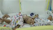فصل توأمين ملتصقتين من الرأس بمساعدة الذكاء الاصطناعي في جراحة نادرة