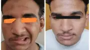 فريق طبي بجامعة أسيوط يعيد وظائف العصب الوجهي لمريض سرطان الغدة النكفية